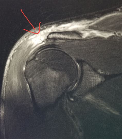 what test shows muscle tears|mri for muscle injury.